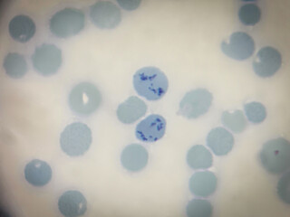 This is reticulocyte by microscopic 100x lens. Used to look at red blood cell production in the bone marrow.