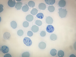 This is reticulocyte by microscopic 100x lens. Used to look at red blood cell production in the...