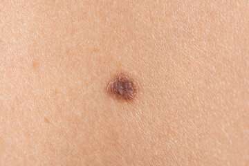 melanocytic pigmented naevus, naevocytic nevus. mole on the skin clos