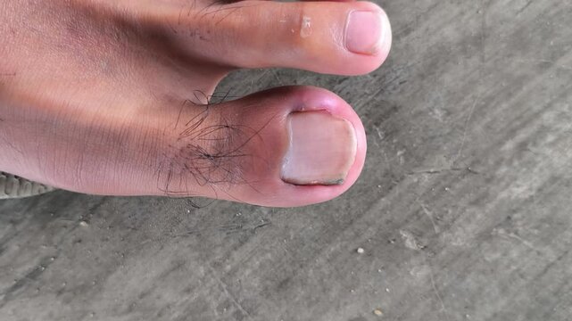 ingrown toenail