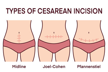 Medical illustration showing three types of cesarean section incisions on female bodies including midline, Joel-Cohen, and Pfannenstiel techniques, explaining surgical options, healing scars