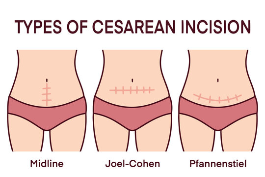 Medical illustration showing three types of cesarean section incisions on female bodies including midline, Joel-Cohen, and Pfannenstiel techniques, explaining surgical options, healing scars