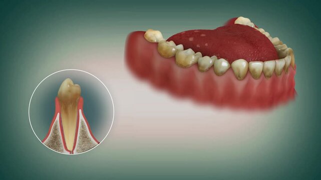 Progression of periodontal disease.Plaque and tartar buildup, gum recession-A close and broad view.