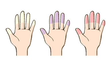 レイノー現象のイラスト・手指の血流障害の症状比較