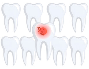 Infected tooth surrounded by healthy teeth.  A graphic representation of dental decay