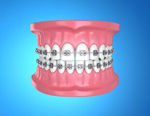 Metal Braces Orthodontic Teeth Alignment Model 3D Illustration