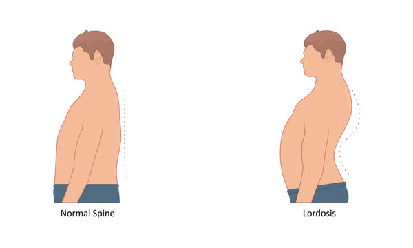 Lordosis vector illustration