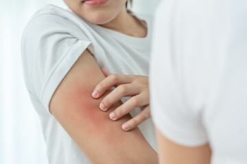 skin problem and beauty. Young woman scratch body has itchy skin from skin allergic, steroid...