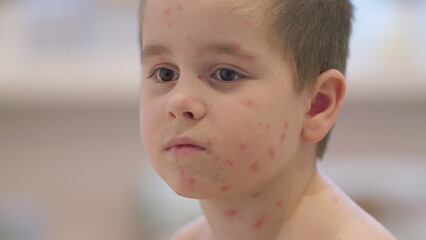 Child exhibiting symptoms associated with Chickenpox, a contagious childhood disease
