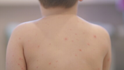 The child is experiencing a skin condition chickenpox affecting their back, which raises concern