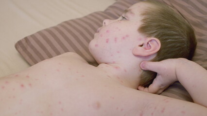 A child with a skin condition is showing red spots chickenpox all over their back area, which is...