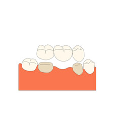 Denture