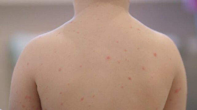 A childs back shows skin irritations chickenpox needing attention and care from healthcare experts