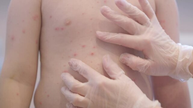 A child with a skin condition chickenpox enjoys their time at the pool, engaging in fun activities