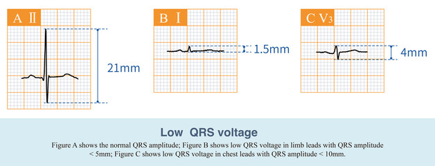 When the QRS amplitude of the limb leads is less than 5mm, it is called limb lead low voltage, and when the QRS amplitude of the chest leads is less than 10mm, it is called chest lead low voltage.
