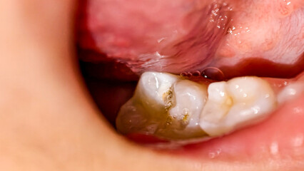 Dental Decay Close-up Showing Tooth Cavities and Gum Inflammation Visible