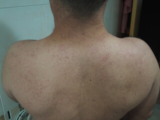 Rear view of a person with eczema and dermatological skin problems.