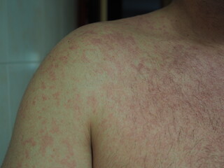 Detail of a person with allergic dermatitis.