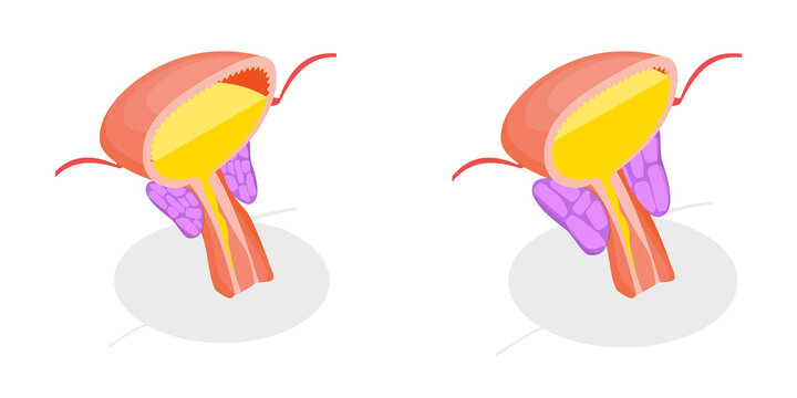 3D Isometric Flat  Illustration of Enlarged Prostate Gland, Benign Prostatic Hyperplasia