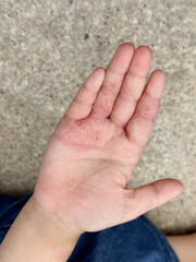 湿疹が出た子供の手の平