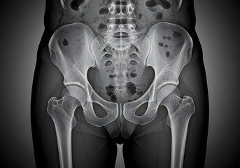 X ray image of human hips and thighs