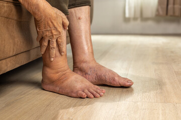 Elderly woman has edema or swelling foot.