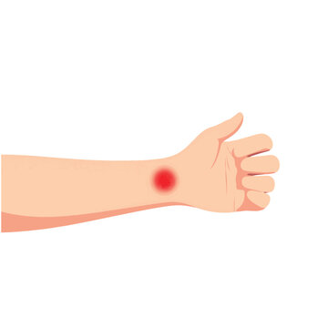 Child's itchy bug bite on forearm, educational medical illustration
