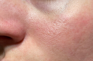 Natural female face close-up showing skin imperfections, large pores, redness and uneven tone....