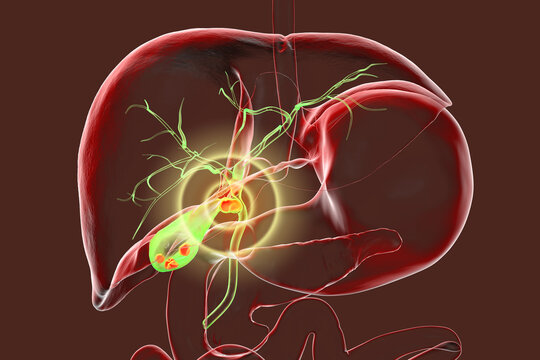 Mirizzi syndrome, 3D illustration showing compression of the common hepatic duct by an impacted gallstone in the cystic duct, causing obstructive jaundice and inflammation.
