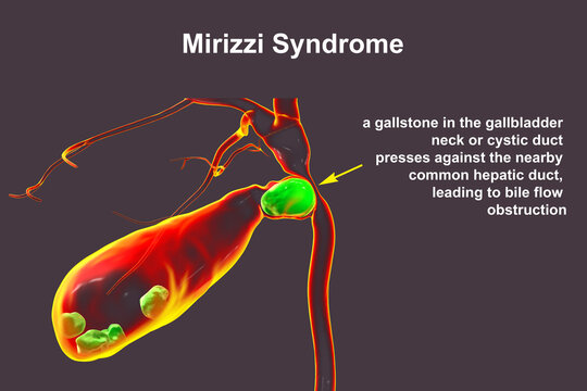 Mirizzi syndrome, 3D illustration showing compression of the common hepatic duct by an impacted gallstone in the cystic duct, causing obstructive jaundice and inflammation.
