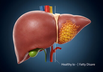 Human liver illustration with fatty liver disease