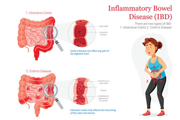 IBD Diagram Comparing Ulcerative Colitis and Crohns Disease with Patient Pain Illustration
