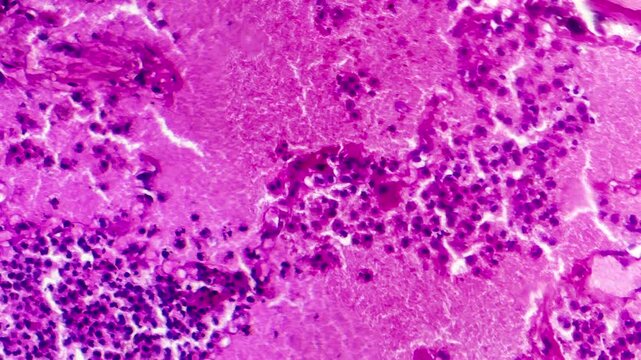 Lobar pneumonia during the hemorrhagic edema period, light microscopy displaying lung tissue inflammation with hemorrhagic changes.