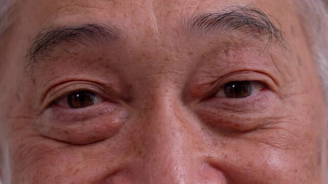 Close up of the senile cataract during eye examination. A white cloudy disc is seen in black eye circle, mature cataract, nuclear sclerosis cataract. Close up half face view