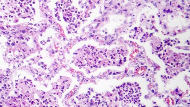 Lobar pneumonia in red hepatic phase, light microscopy displaying inflamed lung tissue with red hepatization.