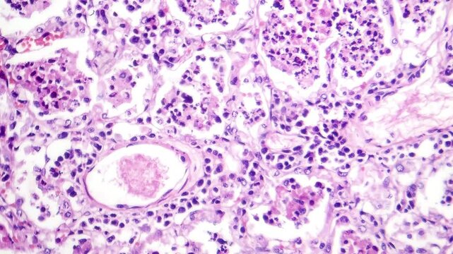 Lobar pneumonia in red hepatic phase, light microscopy displaying inflamed lung tissue with red hepatization.