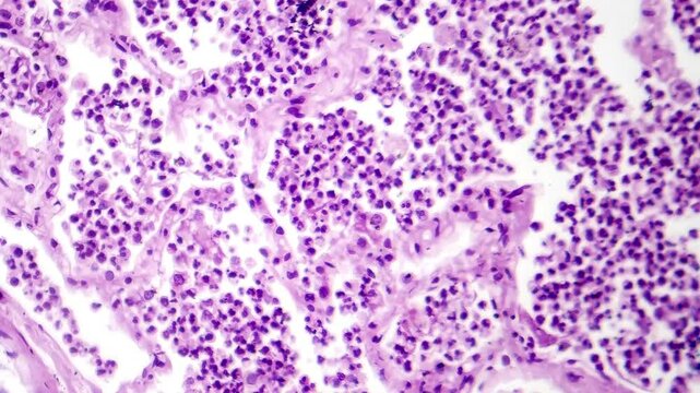 Lobar pneumonia in grey hepatic phase, light microscopy revealing lung tissue transition with exudate-filled alveoli.