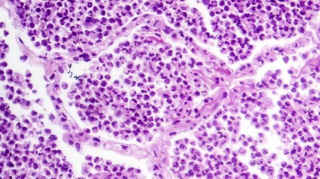 Lobar pneumonia in grey hepatic phase, light microscopy revealing lung tissue transition with exudate-filled alveoli.