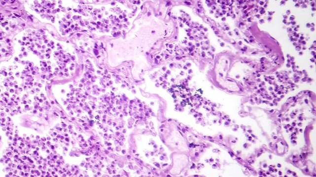 Lobar pneumonia in grey hepatic phase, light microscopy revealing lung tissue transition with exudate-filled alveoli.