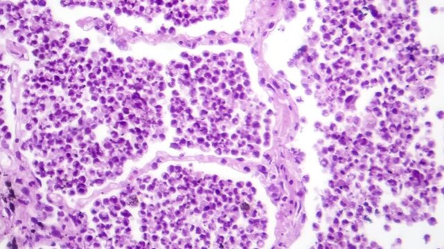 Lobar pneumonia in grey hepatic phase, light microscopy revealing lung tissue transition with exudate-filled alveoli.