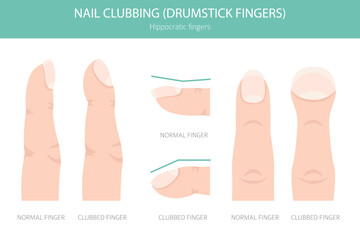 Digital Clubbing Nail Disease - Medical Infographic Vector Illustration