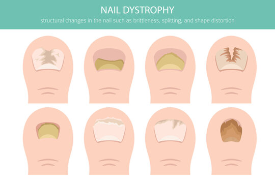 Nail dystrophy. Nail diseases. Medical infographic design.  Vector illustration
