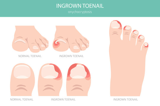 Ingrown toenail, or onychocryptosis, is a nail condition causing pain, redness, and swelling as the nail grows into the skin. Medical infographic. Vector illustration