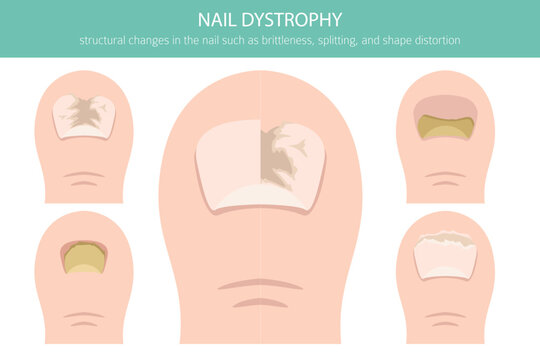 Nail dystrophy. Nail diseases. Medical infographic design.  Vector illustration