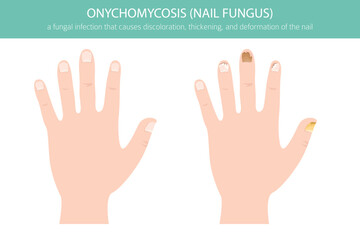 Medical vector illustration of onychomycosis – a common fungal toenail infection. Detailed infographic showing nail discoloration, thickening, and deformationh