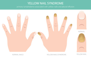 Yellow Nail Syndrome is a rare condition marked by thick, slow-growing yellow nails, often with lymphedema and respiratory issues. Medical infographic. Vector illustration