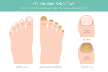 Yellow Nail Syndrome is a rare condition marked by thick, slow-growing yellow nails, often with lymphedema and respiratory issues. Medical infographic. Vector illustration