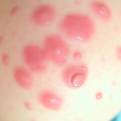 Fototapeta premium Close-up view of inflamed skin exhibiting a cluster of reddish blotches and small papules, suggesting a potential dermatological condition requiring medical assessment.