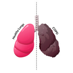 Medical Comparison of Healthy and COPD Lungs Illustration
