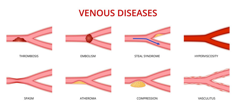 Human vein disease, venous disorders vector set. Thrombosis, embolism, steal syndrome, hyperviscosity, spasm, atheroma, compression and vasculitis. Health care or educational and medical infographics